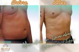 Liposuction in Islamabad Rawalpindi before and After