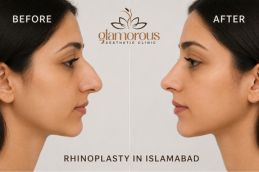 Result of Rhinoplasty