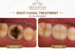 Root canal in Islamabad