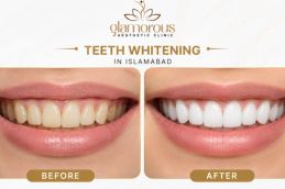 Teeth whitening in Islamabad