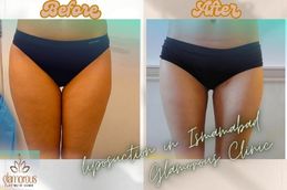 before and After Result Liposuction in Islamabad