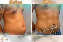 before and After Result Liposuction in Islamabad Pak