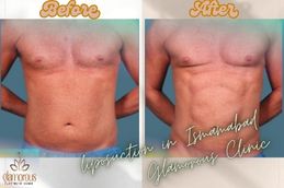 before and After Result Liposuction in Islamabad & Pakistan
