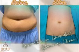 before and After Result Liposuction in Islamabad Rawalpindi & Pak