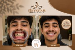 brfore and after root canal result