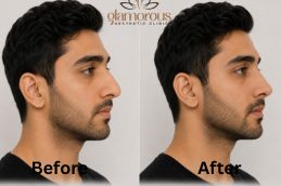 rhinoplasty result before after