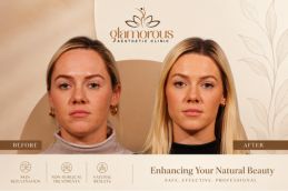 Before and After Fore head Lift in Islamabad Pakistan