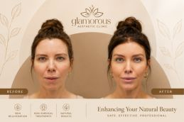 Before and After Fore head Lift in Islamabad Rawalpindi Pakistan