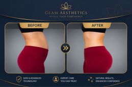 Before and After Lipomatic Treatment in Islamabad