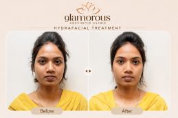 Before and After Result of Hydrafacial in Islamabad Pakistan
