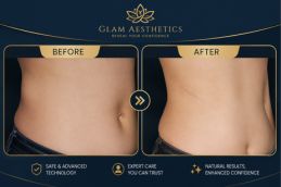 Before and After Result of Lipomatic Treatment in Islamabad