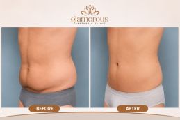 Before and After Result of Tummy Tuck in Rawalpindi Islamabad Pakistan