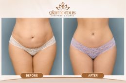 Before and After Result of Tummy Tuck in Rawalpindi & Islamabad