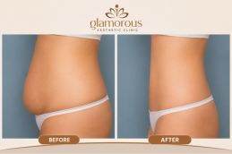 Before and After Result of Tummy Tuck in Rawalpindi