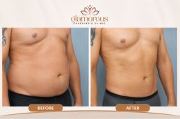 Before and After Results of Tummy Tuck in Islamabad