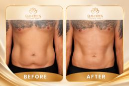 Before and After of Liposuction in Islamabad