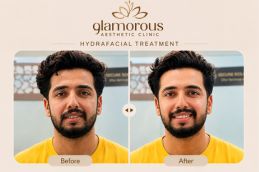HydraFacial treatment result at Glamorous Clinic Islamabad