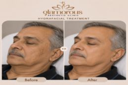 Before and After results of Hydrafacial in Islamabad