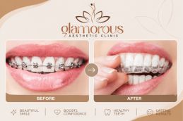 Before and After results of orthodontist in Islamabad