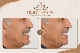 Before and After results of orthodontist in rawalpindi Islamabad