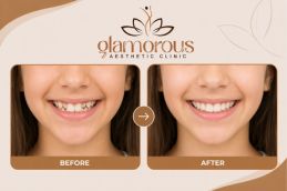 Before and After results of orthodontist in rawalpindi