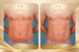 Before and after Liposuction In Islamabad