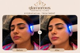 HydraFacial before and after skin Islamabad patient