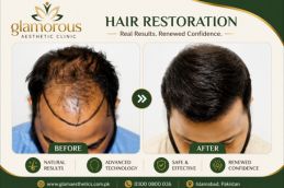 Best Hair Transplant Result in Islamabad