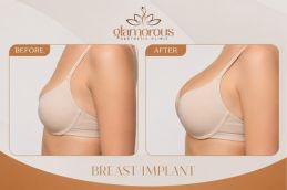 Breast implants before and After results in Islamabad & Pakistan