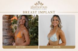 Breast implants before and After results in Islamabad