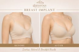 Breast implants before and After results