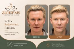 Fore head Lift result in Islamabad Pakistan