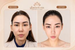 Fox Eye Surgery before and after Islamabad Rawalpindi Pakistan