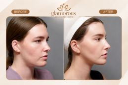 Fox Eye Surgery before and after Islamabad Rawalpindi