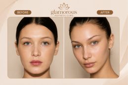 Fox Eye Surgery before and after Rawalpindi Pakistan