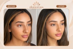 Fox Eye Surgery before and after in Islamabad Rawalpindi