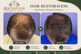 Hair Transplant Result in Islamabad rawalpindi Pakistan