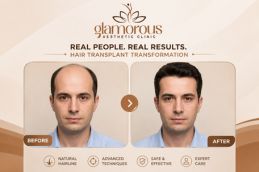 Hair Transplant Result
