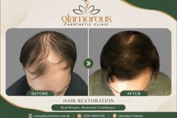 Hair Transplant Results in Islamabad Pakistan