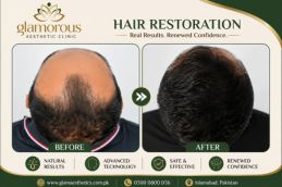 Hair Transplant Results in Islamabad rawalpindi Pakistan