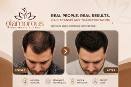 Hair Transplant Results in Islamabad