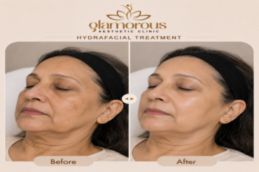 Hydrafacial in Islamabad Old lady result