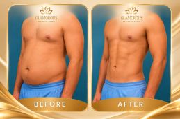 Liposuction before and after in Islamabad and Pakistan