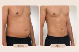Liposuction before and after