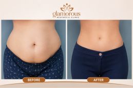 Result of Tummy Tuck in Islamabad & Pakistan