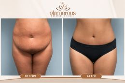 Result of Tummy Tuck in Islamabad & Pakistan