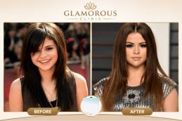 before-and-After-result-of-breast-surgery