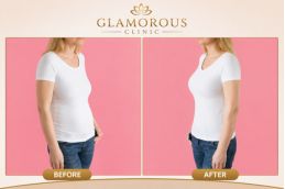 before and After results of breast surgery in Islamabad