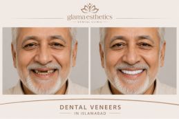 before and after of Dental veneers in Rawalpindi & Pakistan