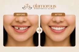 before and after results dental implant in Islamabad
